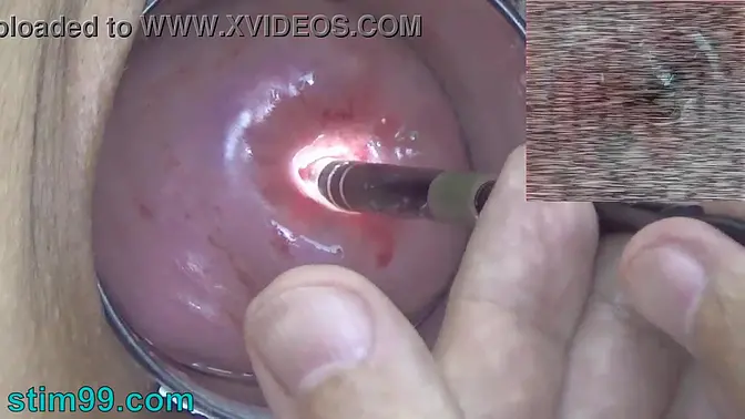 Crazy gyno exam: Wife's cervix and womb inspected on camera