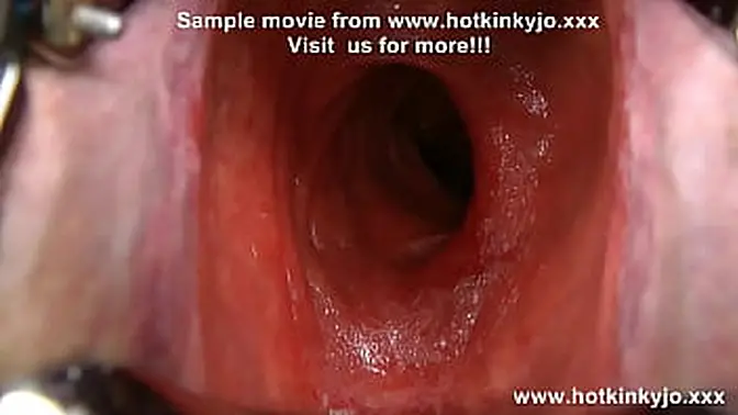 Anal gape and belly bulge with a gigantic speculum